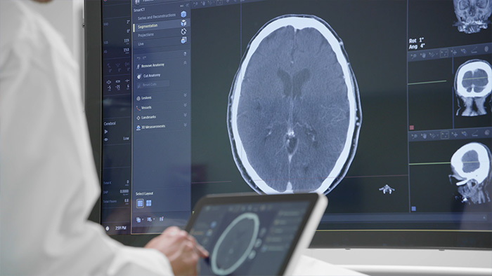 Tratamiento del accidente cerebrovascular isquémico